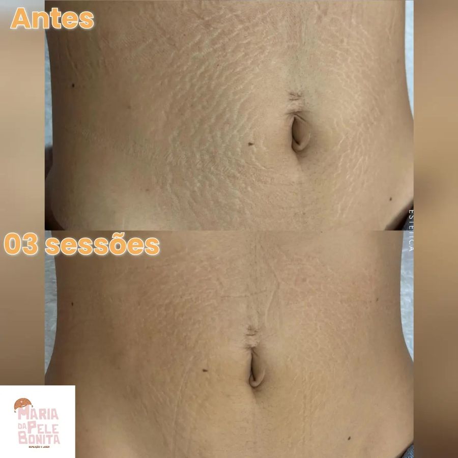 Antes e depois de 3 sessões de tratamento de estrias no abdômen — paciente da clínica