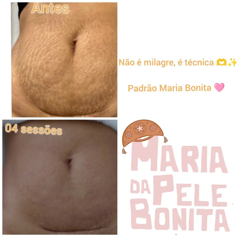 Antes e depois de tratamento de estrias — paciente da clínica
