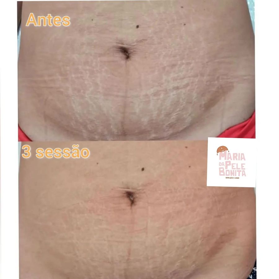 Antes e depois de tratamento de estrias — paciente da clínica