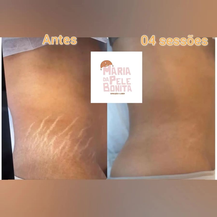 Antes e depois de tratamento de estrias — paciente da clínica