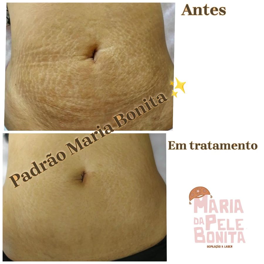 Antes e depois de tratamento de estrias — paciente da clínica