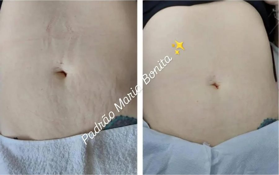 Antes e depois de tratamento de estrias — paciente da clínica